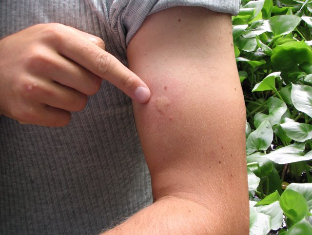 Šta sve možete da uradite da spreèite svrab nakon ujeda komarca
